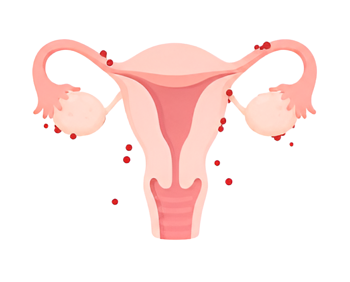 1-endometriose-1