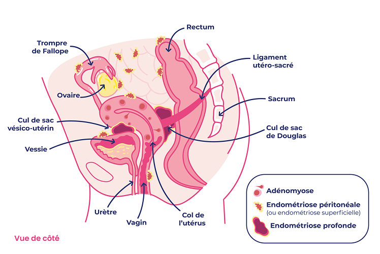 1-endometriose-2x