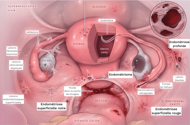 1-endometriose-3