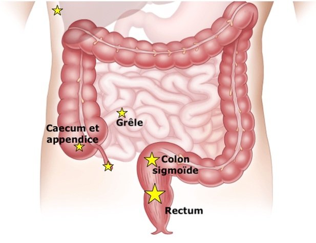1-endometriose-6