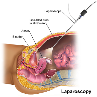 2-laparoscopie-1