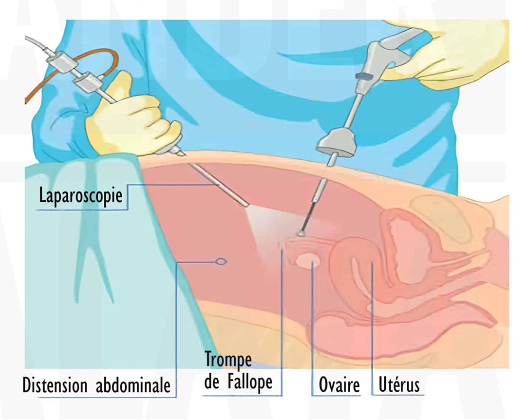 2-laparoscopie-3