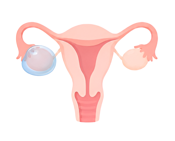 3-kyste ovarian-1