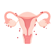Endometriosis
