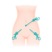 Laparoscopy