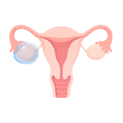 Ovarian cyst